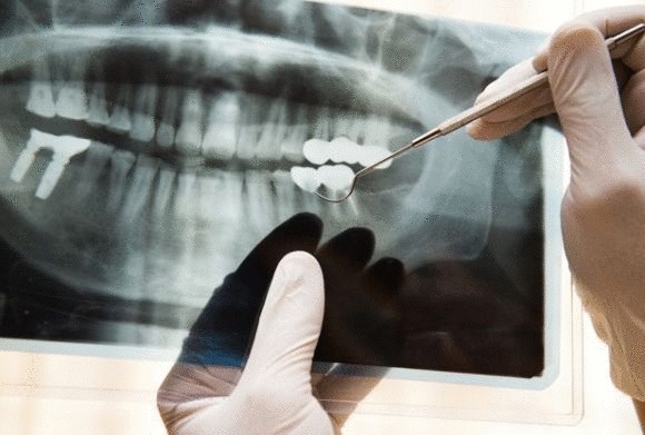 Ученые разработали новый метод протезирования зубов