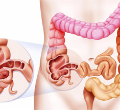 Дырявый кишечник: симптомы, причины и лечение