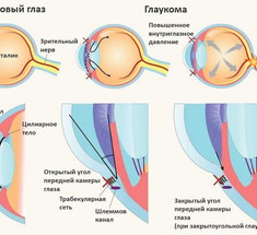 Глаукома: натуральные средства, которые помогут облегчить состояние 