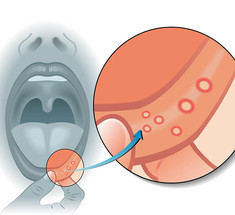 Язвенный стоматит: признаки и лечение