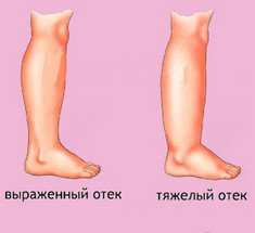6 видов опасных отеков: Причины появления и способы лечения