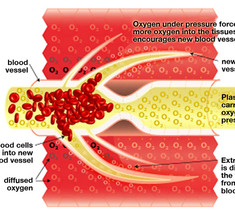 Гипербарическая кислородная терапия как дополнительный метод лечения