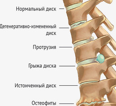 Запрещенные упражнения при грыже межпозвонкового диска