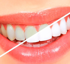 Лучшие способы отбеливания зубов в домашних условиях