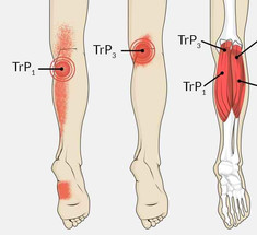Разнообразная и запутанная cимптоматика синдрома беспокойных ног 