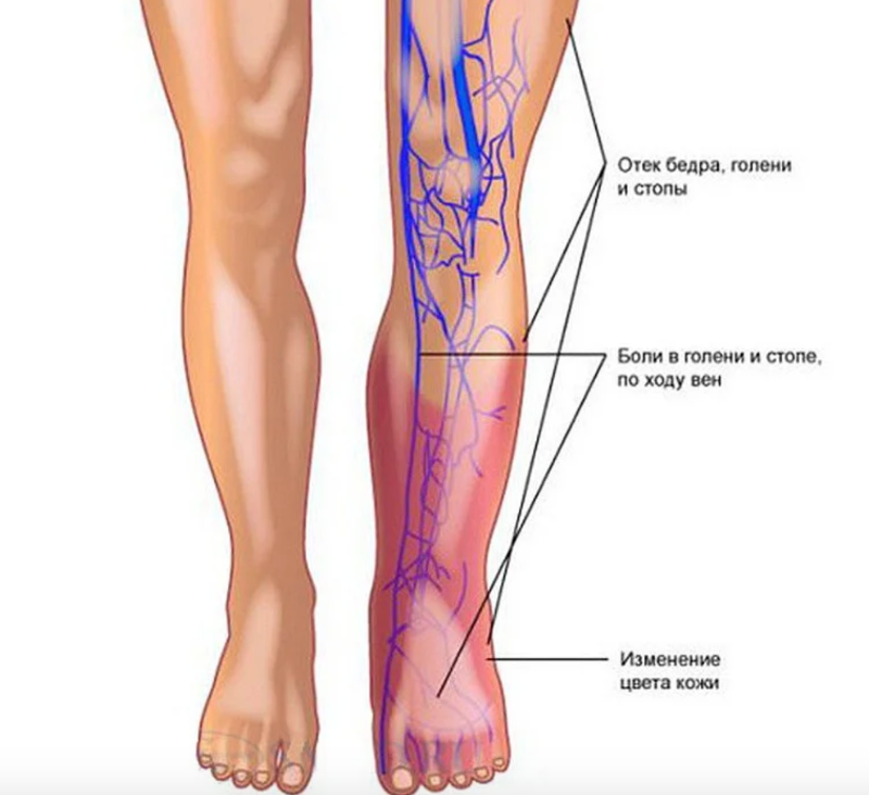 Что делает веня. Тромбофлебит кубитальной вены. Тромбофлебит трофические язвы. Тромбофлебит паховой вены.