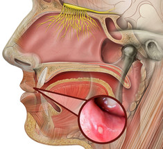 Белые язвочки во рту: причины и лечение