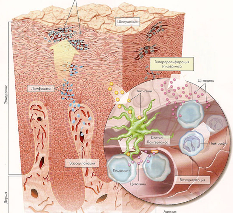 Причины псориаза. Патогенез псориаза. Механизм развития псориаза. Псориаз этиология.