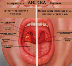 Лечение ангины и воспалений горла без антибиотиков