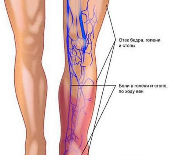 Поверхностный тромбофлебит нижних конечностей симптомы фото 5 самых частых симптомов тромбоза вен нижних конечностей