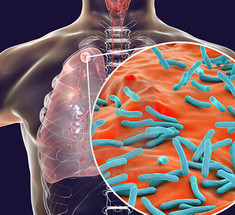 Вторичный туберкулез: Формы и методы лечения