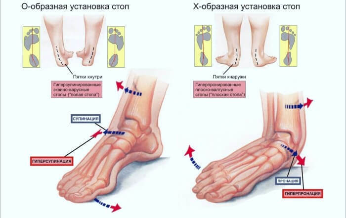 Как исправить плоскостопие