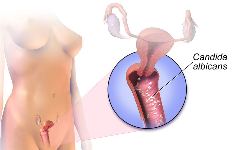 Как вылечить кандидоз натуральными методами