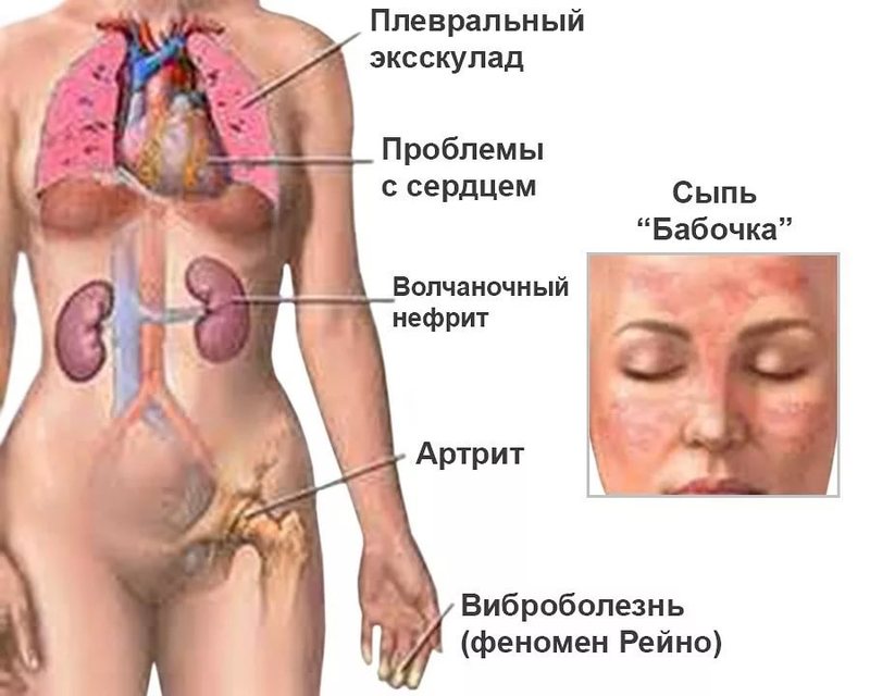 Красная волчанка: 7 домашних способов борьбы с заболеванием