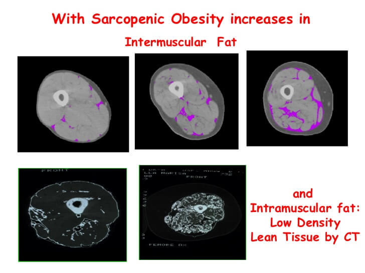 Саркопеническое ожирение: жир вместо мышц