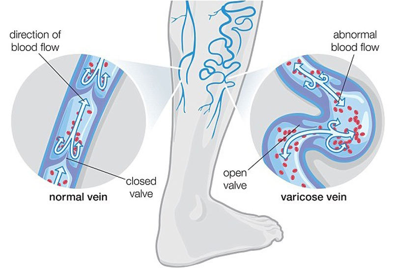 Как заставить спрятаться вены на ногах: 6 рецептов от варикоза