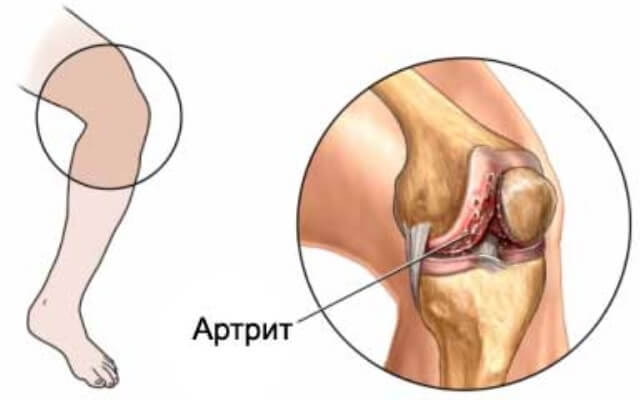 5 мифов об артрите, из-за которых становятся инвалидами