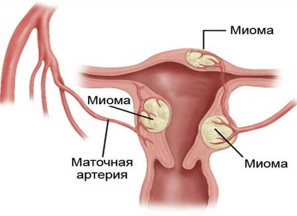 МИОМА МАТКИ: как обойтись без операций и гормональной терапии