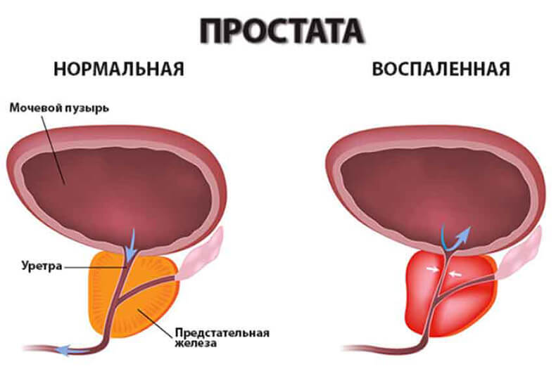 Увеличение простаты: Признаки проблемы