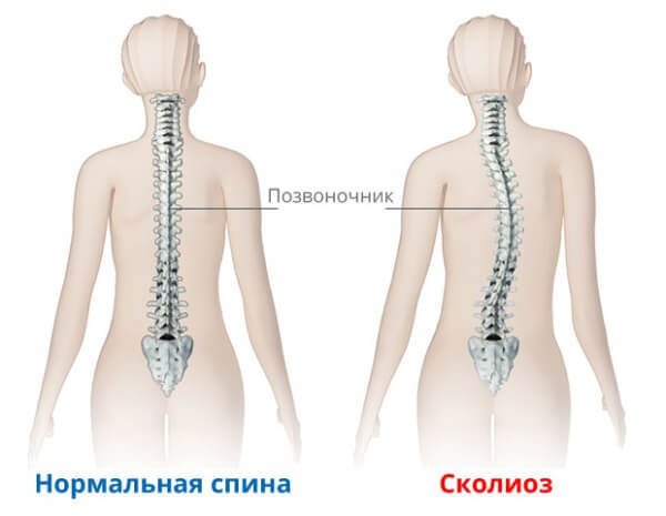 Приобретенный сколиоз: Лечение по методике Гитта