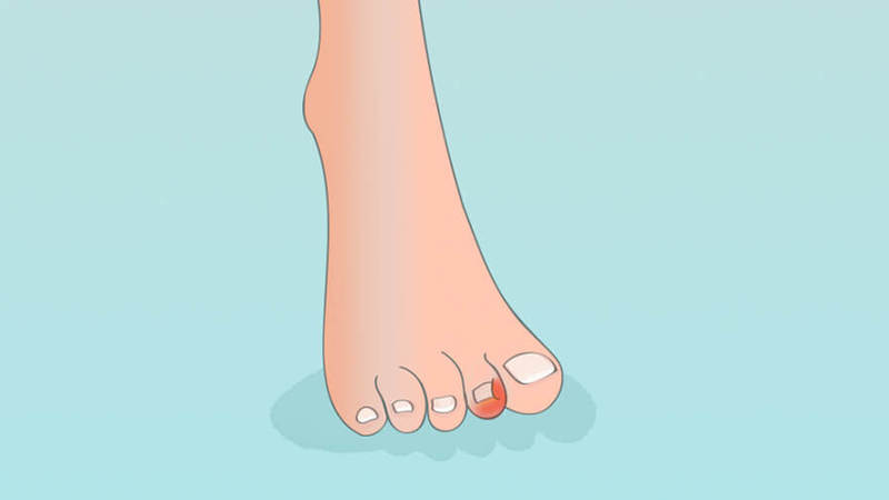 Как лечить вросший ноготь