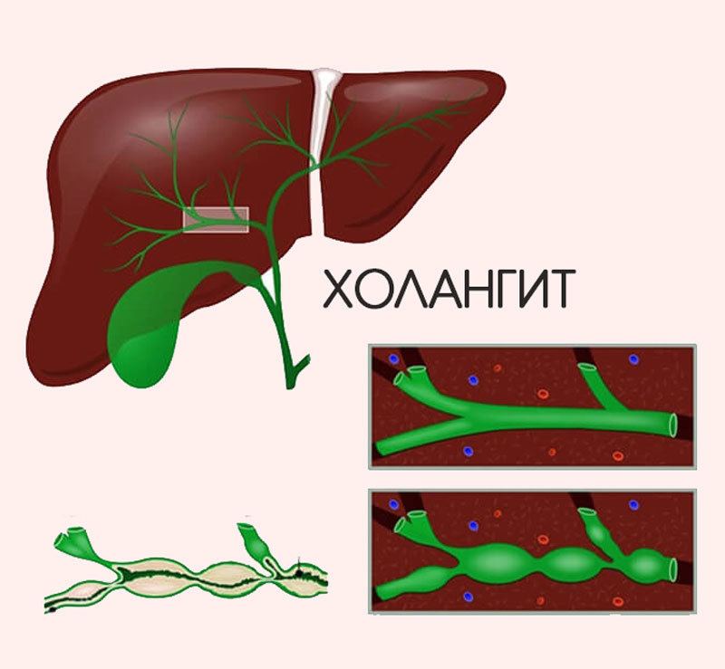 Болезни желчевыводящих путей: чем грозит и что делать