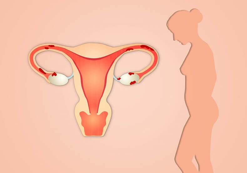 Эндометриоз: ЧТО важно знать женщинам