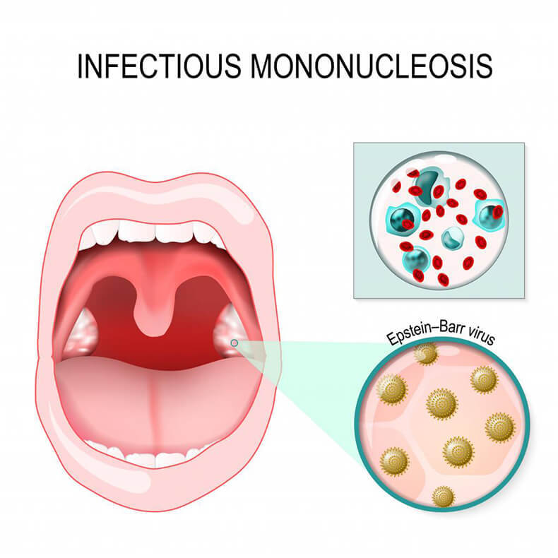 Инфекционный мононуклеоз: Главные признаки заболевания
