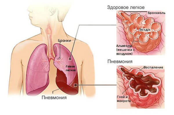 Пневмония у детей и взрослых: Знания, которые спасут жизнь
