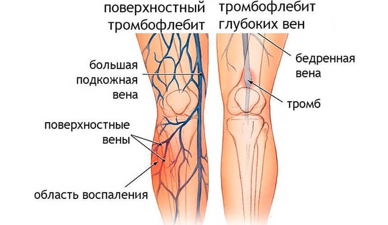 Венозная недостаточность – болезнь цивилизации