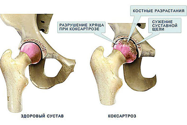 Коксартроз             