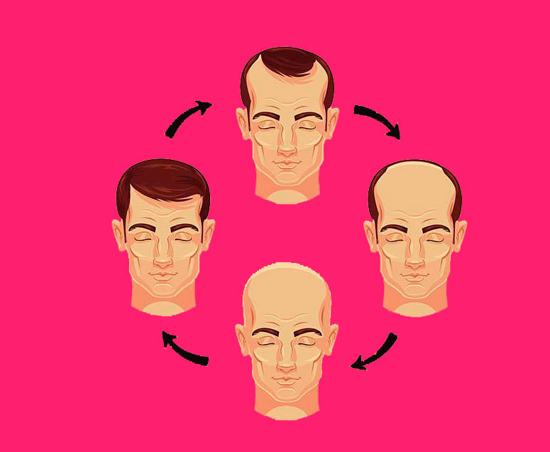 АЛОПЕЦИЯ: Как справиться с выпадением волос при помощи натуральных средств