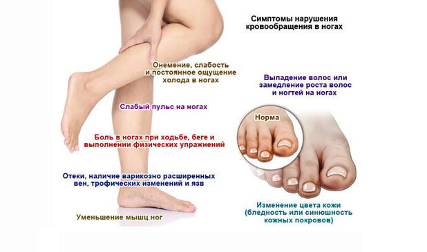 Плохое КРОВООБРАЩЕНИЕ в ногах - как проявляется + эффективные методы лечения