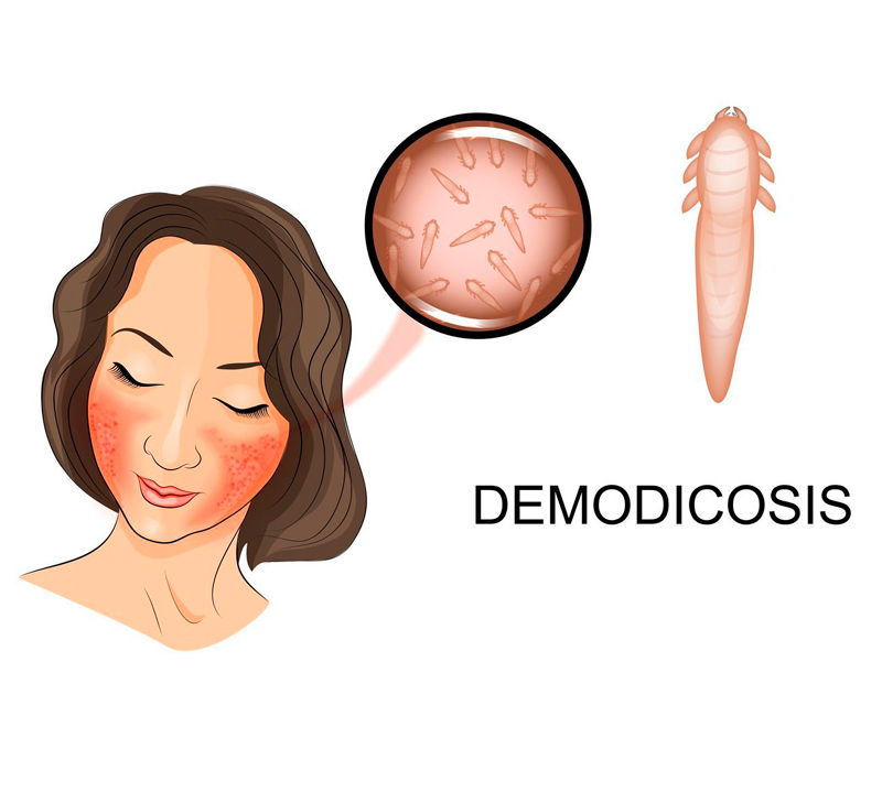 Демодекс: Подкожные клещи на лице – Что делать?