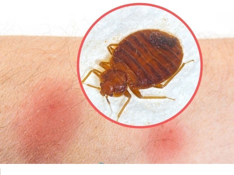 7 укусов насекомых, которые нельзя игнорировать