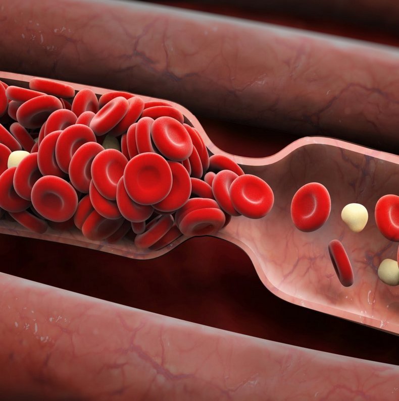 Основная опасность тромбоза вен и причины его возникновения