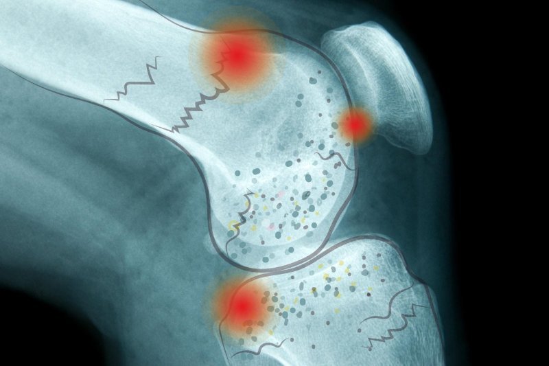 Не упустите время! Натуральные стратегии предотвращения остеопороза
