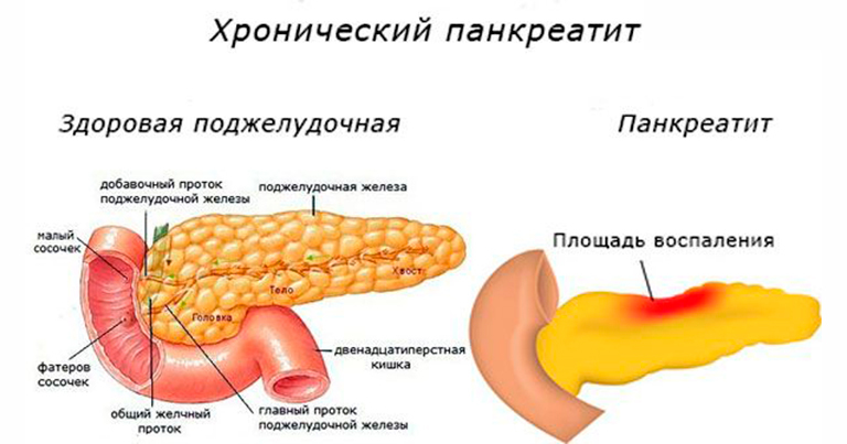 Панкреатит: как питаться на разных стадиях болезни