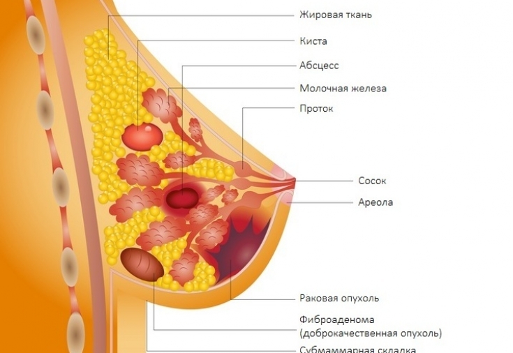 Здоровье груди: что должна знать КАЖДАЯ женщина