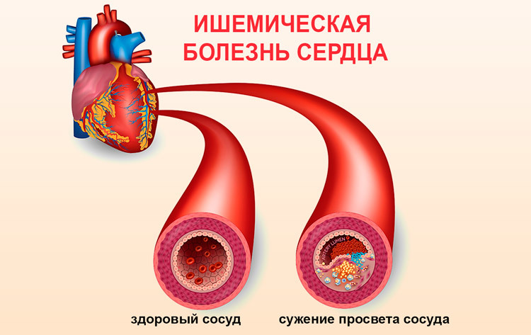 Ишемическая болезнь сердца: кто в зоне риска