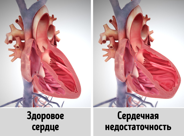 Тревожные признаки сердечной недостаточности