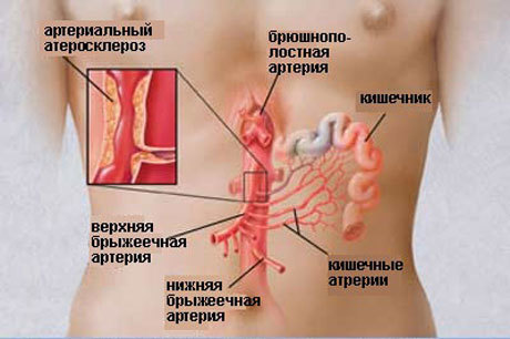Первые симптомы атеросклероза сосудов кишечника